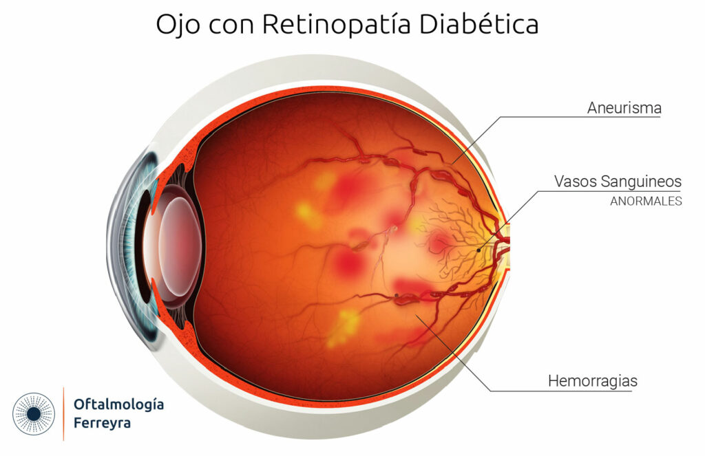 ceguera con diabetes